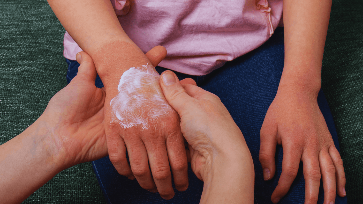 Steroid Creams for Eczema: Risks and Nature’s Alternatives - ALittlePeace